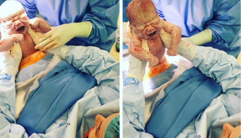 Amazing Moment: Woman Helps Deliver Her Own Baby via Caesarean Section