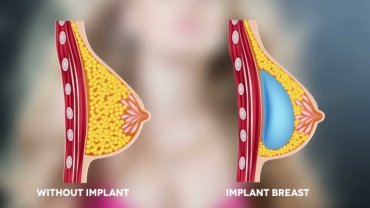 Breast Implants and Pregnancy
