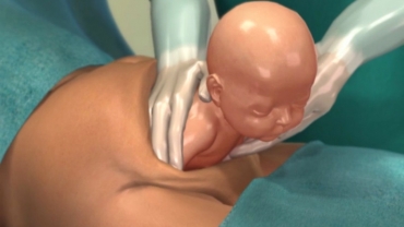 Cesarean Birth (C-section) Procedure