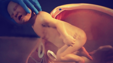 Cesarean Birth Procedure