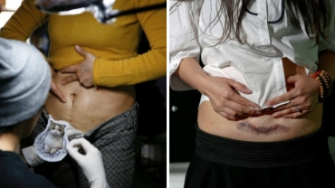 Chinese Mothers Tattoo Over C-Section Scars