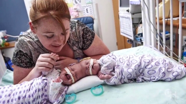 Conjoined Twins Abby and Erin Delaney: A Year in the Life