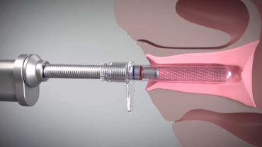 Diva Laser Vaginal Therapy
