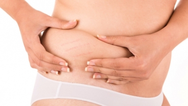 Does a Tummy Tuck (Abdominoplasty) Remove Stretch Marks?