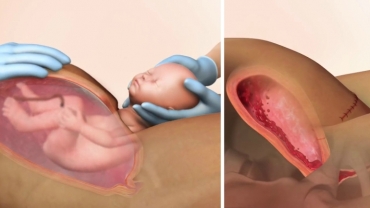 Heavy Bleeding After Birth (Postpartum Hemorrhage)