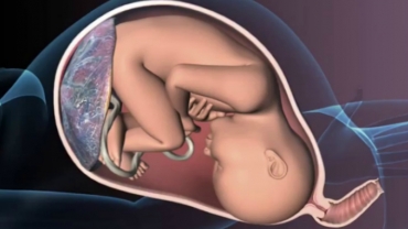 How Does Placental Abruption Affect Baby