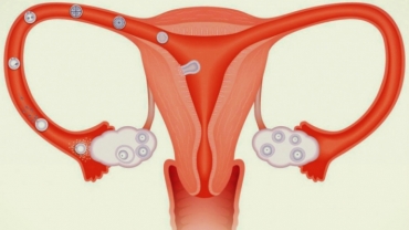 How Does Tubal Sterilization Prevent Pregnancy?