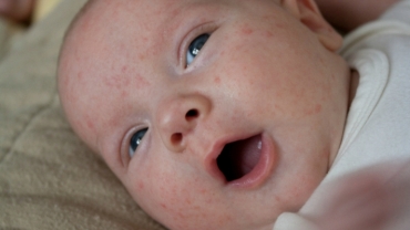 How to Handle Baby Acne?