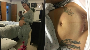 Mom Shares a Graphic Photo of Her Fresh Cesarean Scar