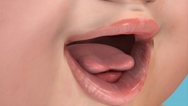 Posterior Tongue Tie Surgery for Infants