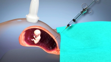 Pregnancy Animation: How Amniocentesis is Performed?