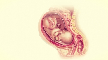 Pregnancy Complications: Placenta Accreta