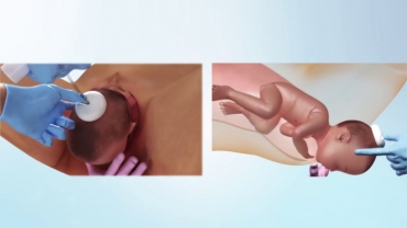 Procedure for Vacuum-Assisted Vaginal Delivery