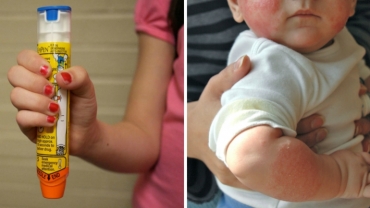 What to Do if Your Baby Has Had a Severe Allergic Reaction?