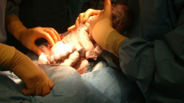 What You Need to Know About Cesarean Birth