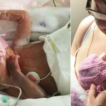 Miracle Baby Born at 24-Weeks with Feet the Size of Pennies