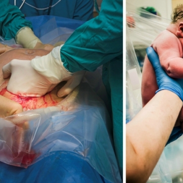 Birth Knowledge: Cesarean Surgery