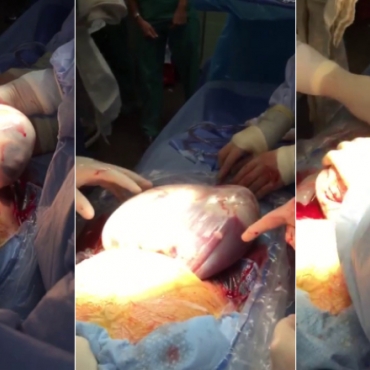 Cesarean Delivery of the Second Twin (Baby Inside Amniotic Sac)