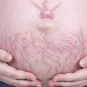 Pregnancy Stretch Marks: Prevention and Treatment