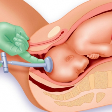What is Involved if You Need an Assisted Birth (Instrumental Delivery)