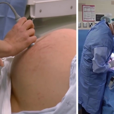 What to Expect Before, During and After Your Caesarean Section