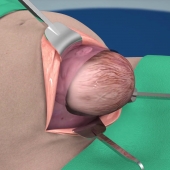 3D Animation: What Happens During a Cesarean Delivery?