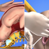 Vacuum-Assisted Vaginal Delivery