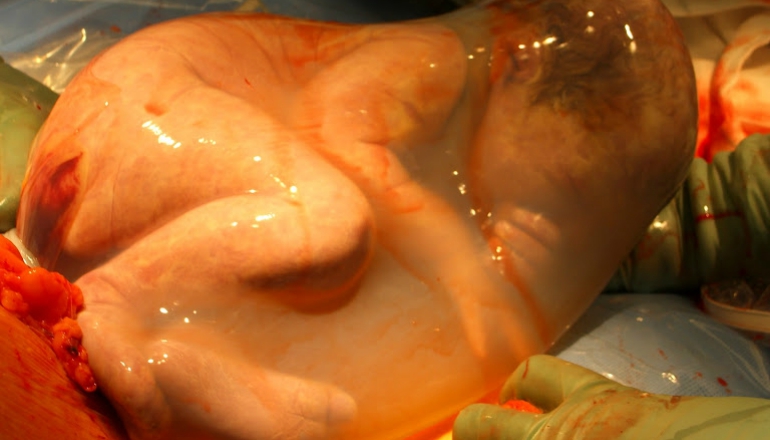 10 Extraordinary Photos of Babies Born in the Amniotic Sac