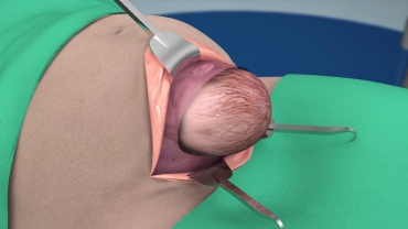 3D Animation: What Happens During a Cesarean Delivery?