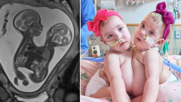 The Separation of Conjoined Twins Lily and Addy Altobelli