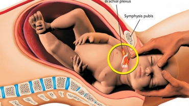 Birth Injuries: What is Erb’s Palsy, and How is it Avoided?