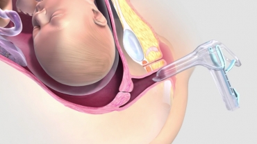 Cervical Ripening Balloon for Labor Induction