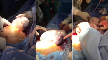 Cesarean Delivery of the Second Twin (Baby Inside Amniotic Sac)