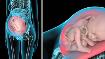 Delivery Complications During Cesarean Section