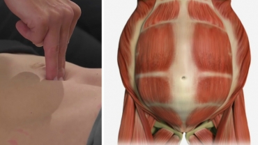 Diastasis Recti: How to Exercise with An Ab Separation After Pregnancy