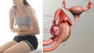 Difference in Ectopic Pregnancy and Normal Pregnancy