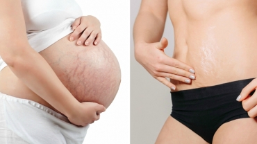 How to Get Rid of Stretch Marks After Pregnancy