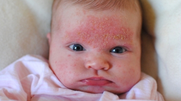 How to Handle Cradle Cap?