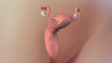 Intrauterine Device (IUD) for Birth Control