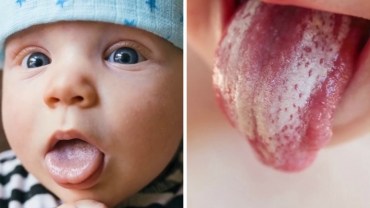 Oral Thrush in Babies