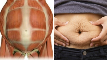 Diastasis Recti and Pregnancy