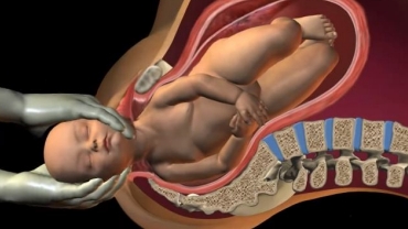 Shoulder Dystocia at Birth