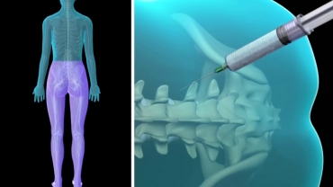 Spinal And Epidural Anesthesia