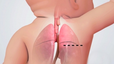 Tracheoesophageal Fistula Repair in Newborn Babies