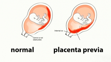 What Types of Birth Require a C-Section?