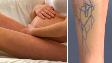 Why Do Varicose Veins Develop in Pregnancy?