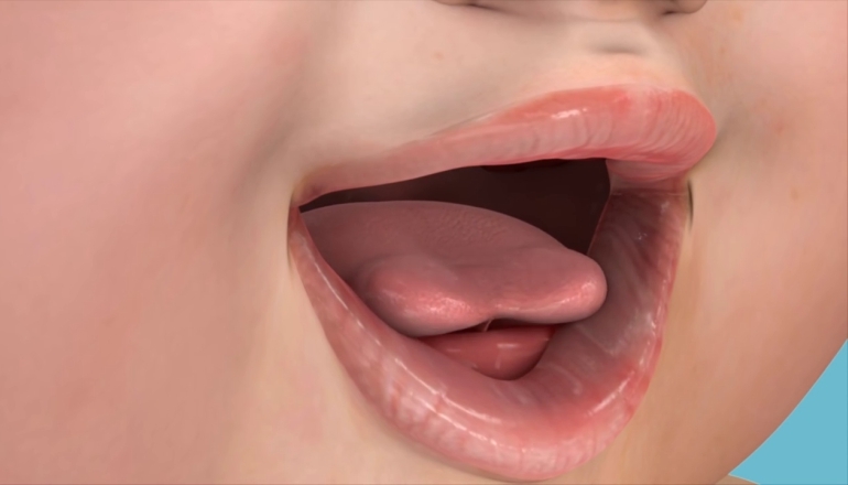 Posterior Tongue Tie Surgery for Infants