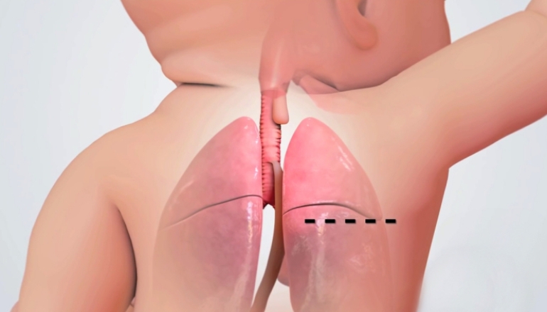 Tracheoesophageal Fistula Repair in Newborn Babies