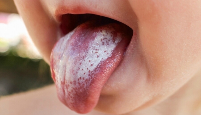 When to Worry About Oral Thrush in Babies?