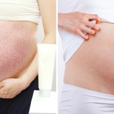 6 Annoying Pregnancy Skin Issues (And How to Deal)